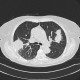 Angioinvasive aspergilosis, first CT: CT - Computed tomography